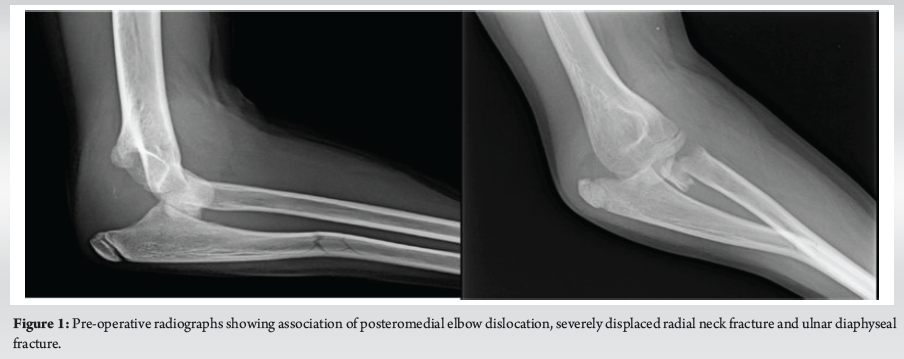 Displaced Elbow Elbow Dislocation Associated with Severely Displaced Radial Neck ...