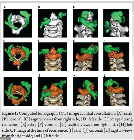 A Case of Atlanto-Axial Rotatory Fixation Requiring Internal Fixation ...