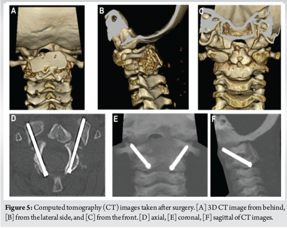A Case of Atlanto-Axial Rotatory Fixation Requiring Internal Fixation ...