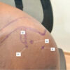 Clinical Outcomes of Clinico-radiologically Predetermined Patient Specific Multi-site Steroid Injection in Primary Frozen Shoulder: A Prospective Case Series