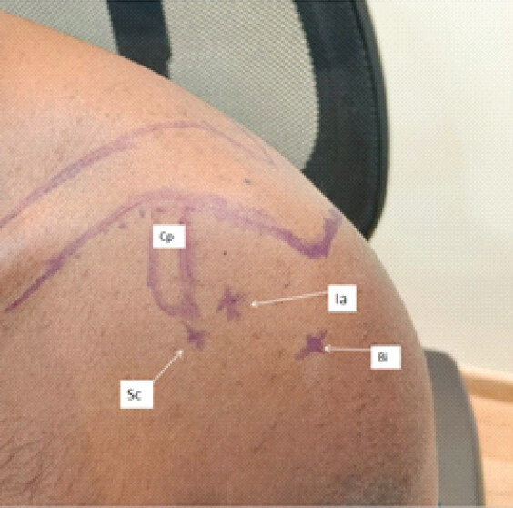 Figure 1: Illustration of surface marking of shoulder for subcoracoid (Sc), intra-articular (Ia) and biceps (Bi) injections and coracoid process (Cp) viewed from anterior.