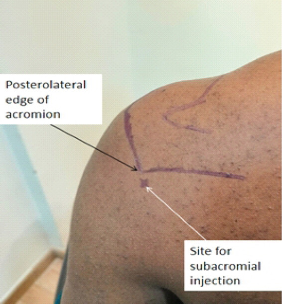 Figure 2: Illustration of shoulder surface marking of site for subacromial (SA) injection viewed from posterior