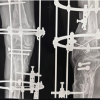Knee Arthodesis, As a Salvage Procedure for Non-union of Floating Knee after Ilizarov Fixation-A Case Report