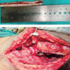 Functional Outcome of Femoral Neck Fractures with Posterior Comminution Managed by Dynamic Hip Screw with Fibular Strut Grafting: A Case Series Study