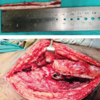 Figure 1: (a) Harvested fibular strut graft and (b) intraoperative picture (arrow indicates fibular strut graft).