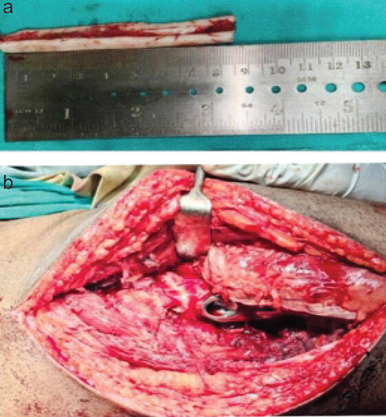 Figure 1: (a) Harvested fibular strut graft and (b) intraoperative picture (arrow indicates fibular strut graft).