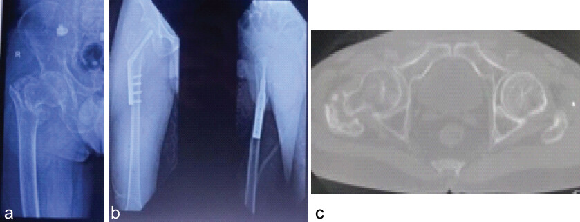 Figure 2: Patient 1 (a) Pre-operative radiograph, (b) pre-operative CT, and (c) post-operative radiograph.