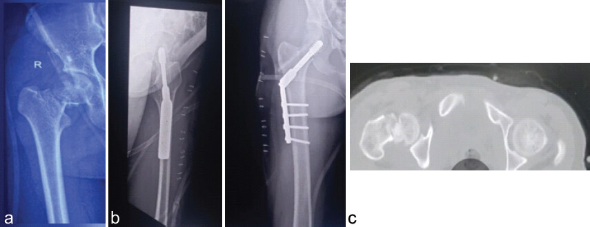 Figure 3: Patient 2 (a) Pre-operative radiograph, (b) pre-operative CT, and (c) post-operative radiograph.