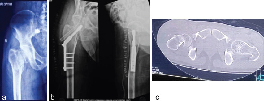 Figure 4: Patient 3 (a) Pre-operative radiograph, (b) pre-operative CT, and (c) post-operative radiograph.