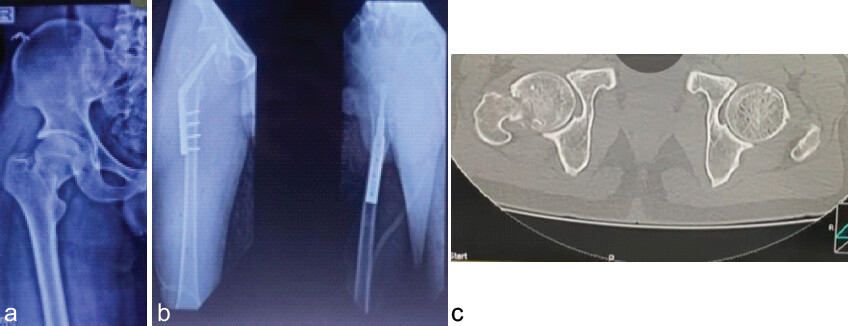 Figure 5: Patient 4 (a) Pre-operative radiograph, (b) pre-operative CT, and (c) post-operative radiograph.