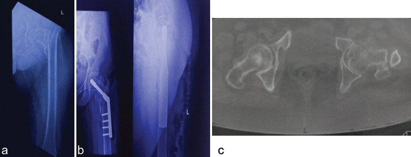 Figure 6: Patient 5 (a) Pre-operative radiograph, (b) pre-operative CT, and (c) post-operative radiograph.