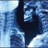 Pediatric Cervical Spine Aneurysmal Bone Cyst with Recurrent Atlantoaxial Rotatory Subluxation Requiring C1–C2 Fusion: A 7-Year Follow-Up Case Report