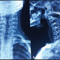 Figure 1: Pre-operative X-rays (a) anteroposterior view, (b) lateral view.