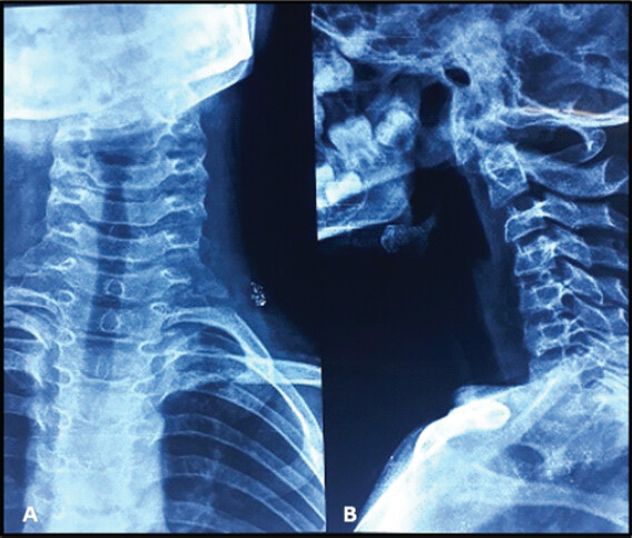 Figure 1: Pre-operative X-rays (a) anteroposterior view, (b) lateral view.
