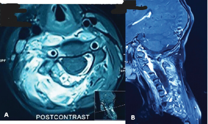 Figure 2: Pre-operative contrast-enhanced magnetic resonance imaging of the patient. (a) Axial view, (b) sagittal view.