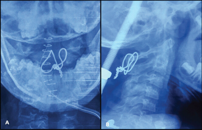 Figure 3: Post-operative X-rays following Gallie’s fusion. (a) Anteroposterior view, (b) lateral view.