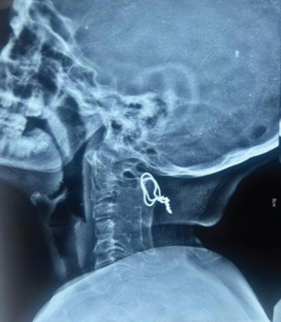 Figure 4: A 7-year follow-up X-ray of the patient.