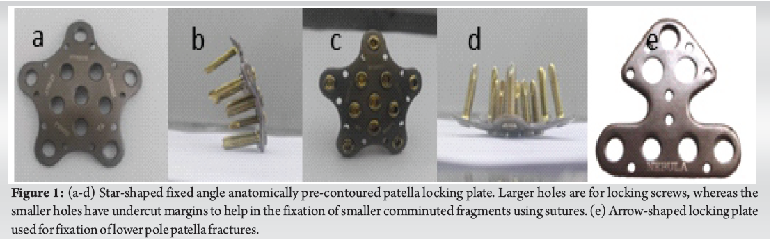 Outcome Analysis of Fixed angle Locking Plate in Comminuted Patella ...