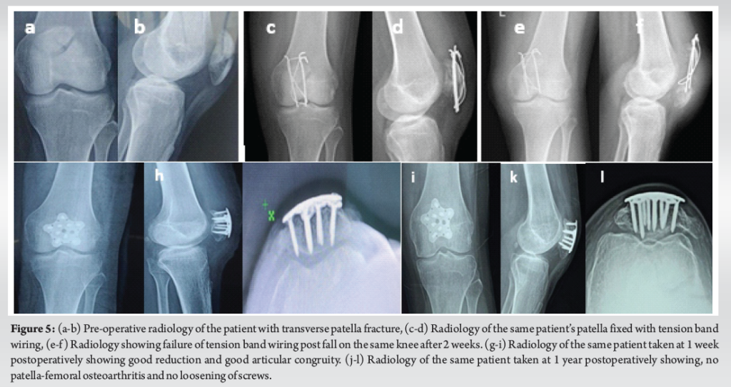 Outcome Analysis of Fixed angle Locking Plate in Comminuted Patella ...