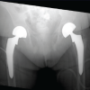 Bilateral Total Hip Arthroplasties Secondary to Renal Osteodystrophy in a Patient with a Rare Cromer Antibody: A Case Report