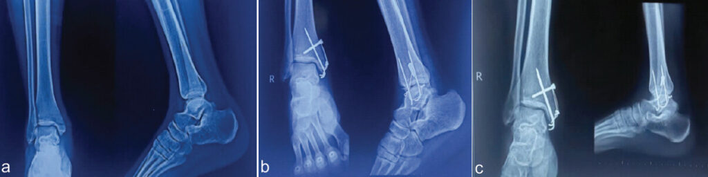 Figure 2: Case 1 – (a) Pre-operative X-ray. (b) Immediate post-operative X-ray. (c) Six-month follow-up X-ray.