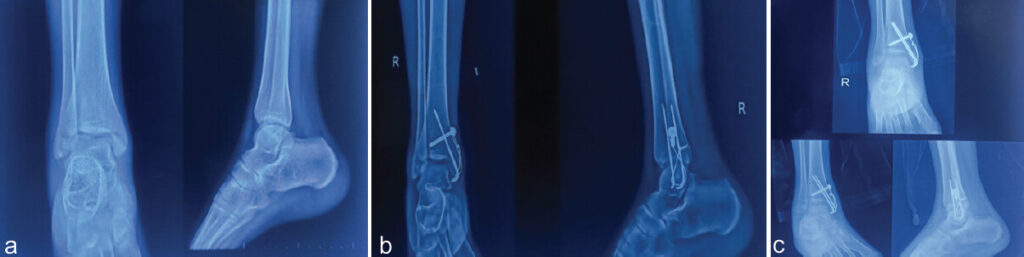 Figure 3: Case 2 – (a) Pre-operative X-ray. (b) Immediate post-operative X-ray. (c) Six-month follow-up X-ray.