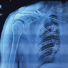 From Nail to Fail: Complications Encountered with Clavicle Nailing – A Series of 3 Cases