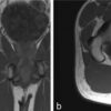Total Hip Arthroplasty in the Adolescent Population: A Case Series