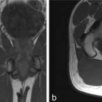 Figure 1: Magnetic resonance imaging T1 sequences show coronal image (a) and axial imaging (b) of the right hip demonstrating increased signal in the femoral head and associated collapse, indicative of avascular necrosis.