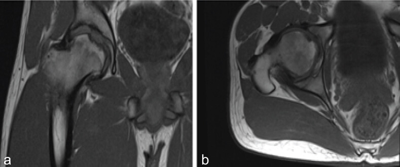 Figure 1: Magnetic resonance imaging T1 sequences show coronal image (a) and axial imaging (b) of the right hip demonstrating increased signal in the femoral head and associated collapse, indicative of avascular necrosis.