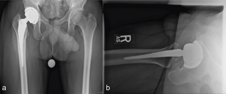 Figure 2: Anteroposterior (a) and lateral (b) radiographs show total hip arthroplasty.