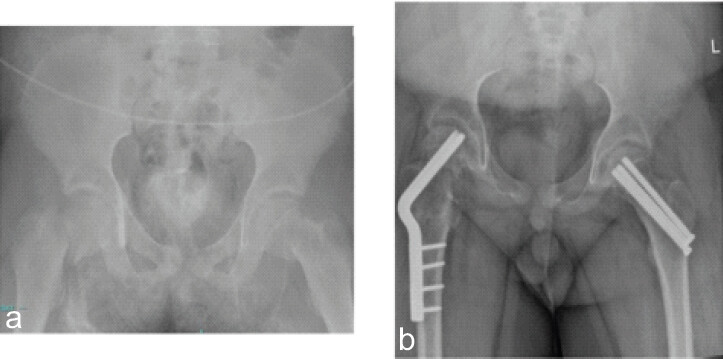 Figure 3: (a) Anteroposterior pelvis radiograph shows bilateral displaced femoral neck fractures in a skeletally immature male. (b) Anteroposterior pelvis radiograph shows post-operative right femoral head collapse with advancement of blade plate.