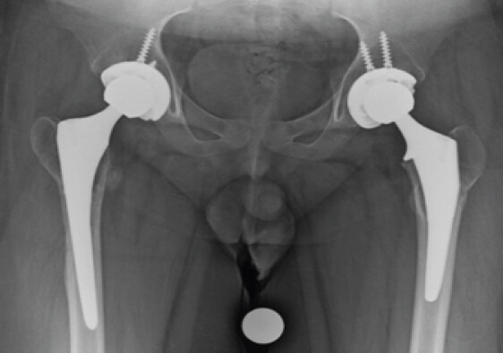 Figure 4: Anteroposterior pelvis with marker ball demonstrating bilateral total hip arthroplasties.