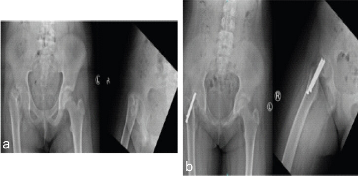 Figure 5: (a) Anteroposterior (left) and frog-leg lateral (right) radiographs show a severe right slipped capital femoral epiphysis. (b) Anteroposterior pelvis (left) and lateral (right) radiographs show 6 weeks post-operative femoral head collapse with advancement of hardware.
