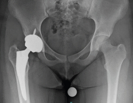 Figure 6: Antaxeroposterior pelvis radiograph shows right total hip arthroplasty 4 years post-operatively.