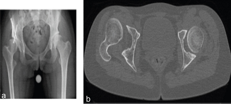 Figure 7: (a) Anteroposterior pelvis 6 months post-operatively from periacetabular osteotomy shows persistent subluxation of the right femoral head. (b) Pre-operative axial computed tomography scan demonstrating anterior subluxation of the femoral head.