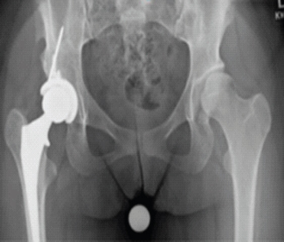 Figure 8: Anteroposterior pelvis shows post-operative radiograph after robotic-assisted right hip arthroplasty and removal of hardware.