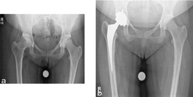 Figure 9: (a) Anteroposterior pelvis shows worsening of right hip avascular necrosis with coxa magna and subchondral sclerosis. (b) Anteroposterior pelvis radiograph shows the total hip arthroplasty 2 years post-operatively.
