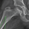 Developmental Hip Dysplasia Presenting as Bilateral Osteochondritis Dissecans Perthes-like Lesions Treated with Triple Pelvic Osteotomies: A Case Report