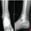 Chronic Syndesmotic Instability Associated with a Complex Lesion of the Posterior Inferior Tibiofibular Ligament: Review, Case Report, and Surgical Report