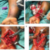 Evaluation of Functional Outcome of Extended Flexor Carpi Radialis Approach for Fracture Fixation of Distal End Radius Fracture