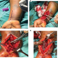 Figure 1: Intraoperative sequence of the extended flexor carpi radialis approach. (a) volar skin marking along the FCR interval; (b) extensile volar exposure; (c) visualization after release and fragment mobilization; and (d) volar locking plate fixation.