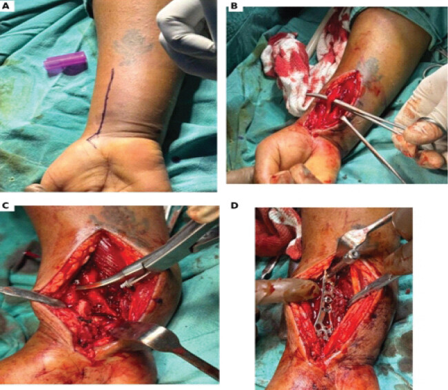 Figure 1: Intraoperative sequence of the extended flexor carpi radialis approach. (a) volar skin marking along the FCR interval; (b) extensile volar exposure; (c) visualization after release and fragment mobilization; and (d) volar locking plate fixation.