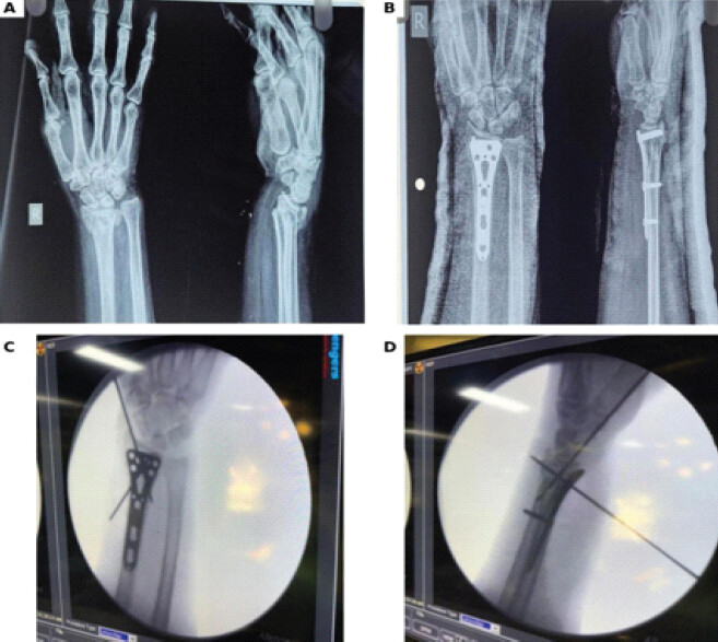 Figure 2: (a) Pre-operative posteroanterior and lateral radiographs, (b) post-operative radiographs after volar locking plate fixation, and (c and d) intraoperative fluoroscopic confirmation of reduction and fixation.
