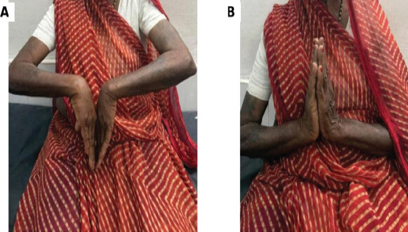 Figure 5: Post-operative clinical photographs demonstrating functional wrist movement at follow-up. Facial identifiers were excluded from the figure.