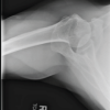 Superior Capsular Reconstruction Using Biceps Tendon Autograft with Novel Biceps Tenodesis Arthroscopic Fixation: A Case Report