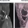Efficacy of Intra-Articular Injection of Platelet-Rich Plasma and Growth Factor Concentrate in Degenerative Meniscal Lesions