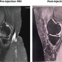Figure 1: Sagittal proton density fat-suppressed magnetic resonance imaging (MRI) of the knee joint before and 9 months following intra-articular orthobiologic injection. Pre-injection MRI demonstrates intrameniscal hyperintense signal alteration, extensive joint effusion, and peri-meniscal soft tissue edema. Post-injection MRI demonstrates resolution of joint effusion, reduction in synovial inflammation, and structural contour stabilization of the meniscal fibrocartilage.