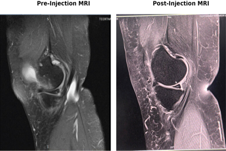 Figure 1: Sagittal proton density fat-suppressed magnetic resonance imaging (MRI) of the knee joint before and 9 months following intra-articular orthobiologic injection. Pre-injection MRI demonstrates intrameniscal hyperintense signal alteration, extensive joint effusion, and peri-meniscal soft tissue edema. Post-injection MRI demonstrates resolution of joint effusion, reduction in synovial inflammation, and structural contour stabilization of the meniscal fibrocartilage.