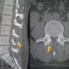 Management of Retained Epidural Catheter Fragment in a Polytrauma Patient: A Case Report